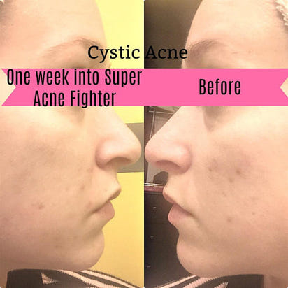 Super Acne Fighter / Organic Acne Treatment / Acne AO