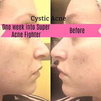 Super Acne Fighter / Organic Acne Treatment / Acne AO